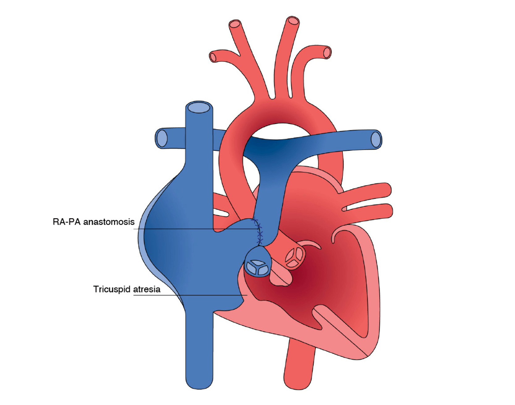 Atrio-pulmonary Connection