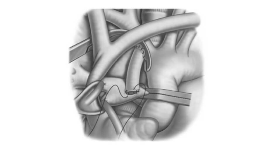 Systemic-to- Pulmonary Artery Shunt