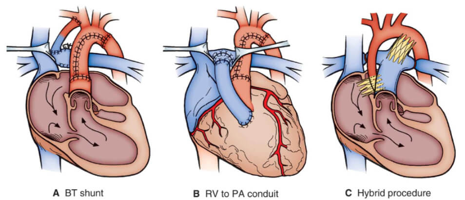 Stage 1 Palliation of Hypoplastic Left Heart Syndrome